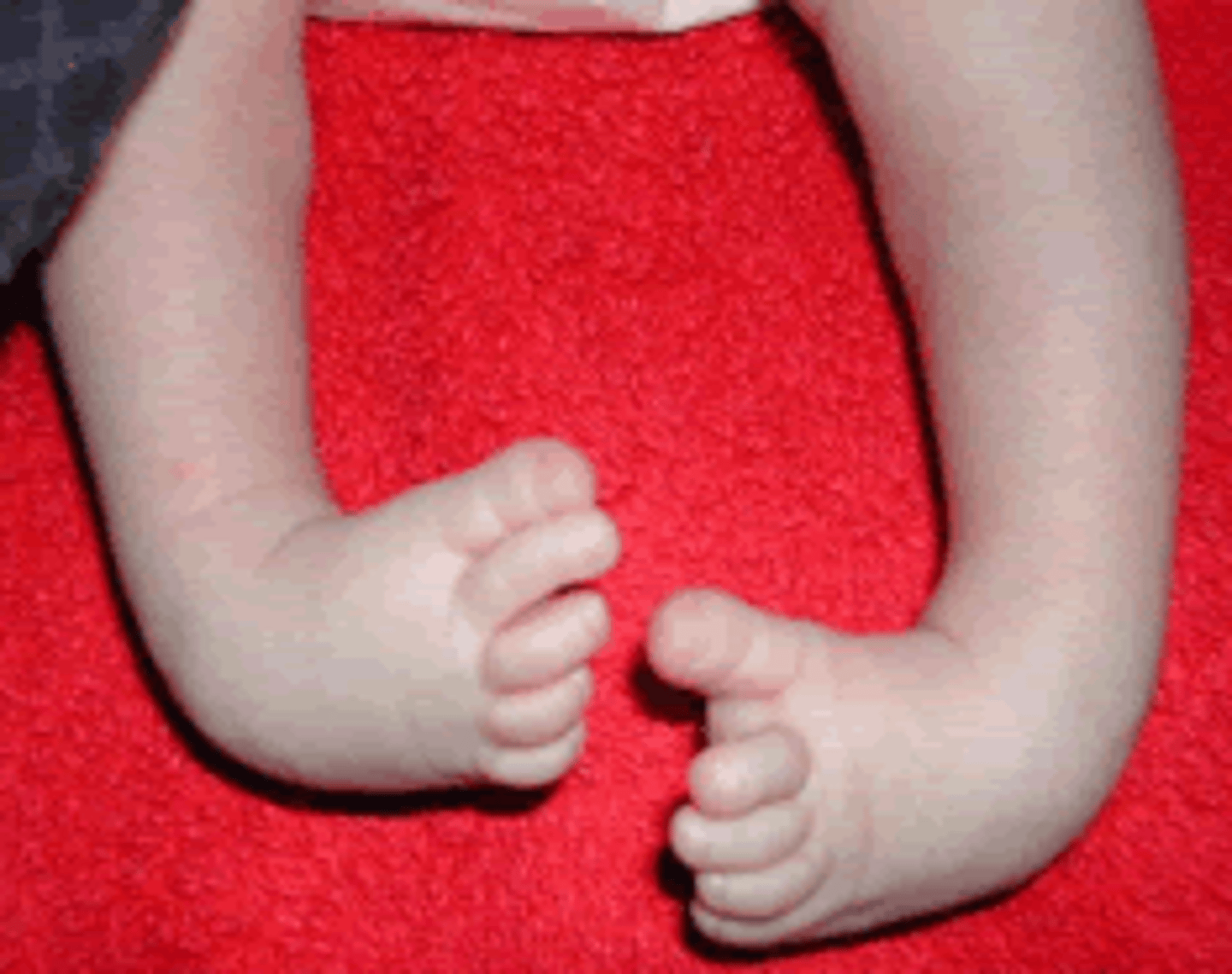 <p>Congenital foot deformity characterized by:</p><p>plantar flexion</p><p>inversion</p><p>adduction</p>