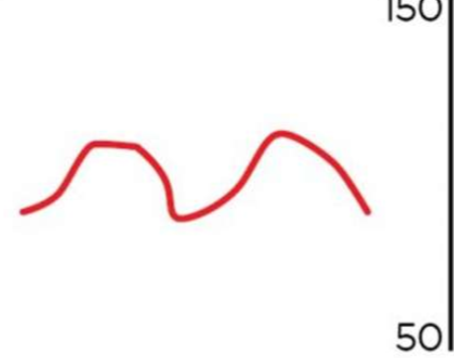 <p>what is occurring in this arterial waveform</p>
