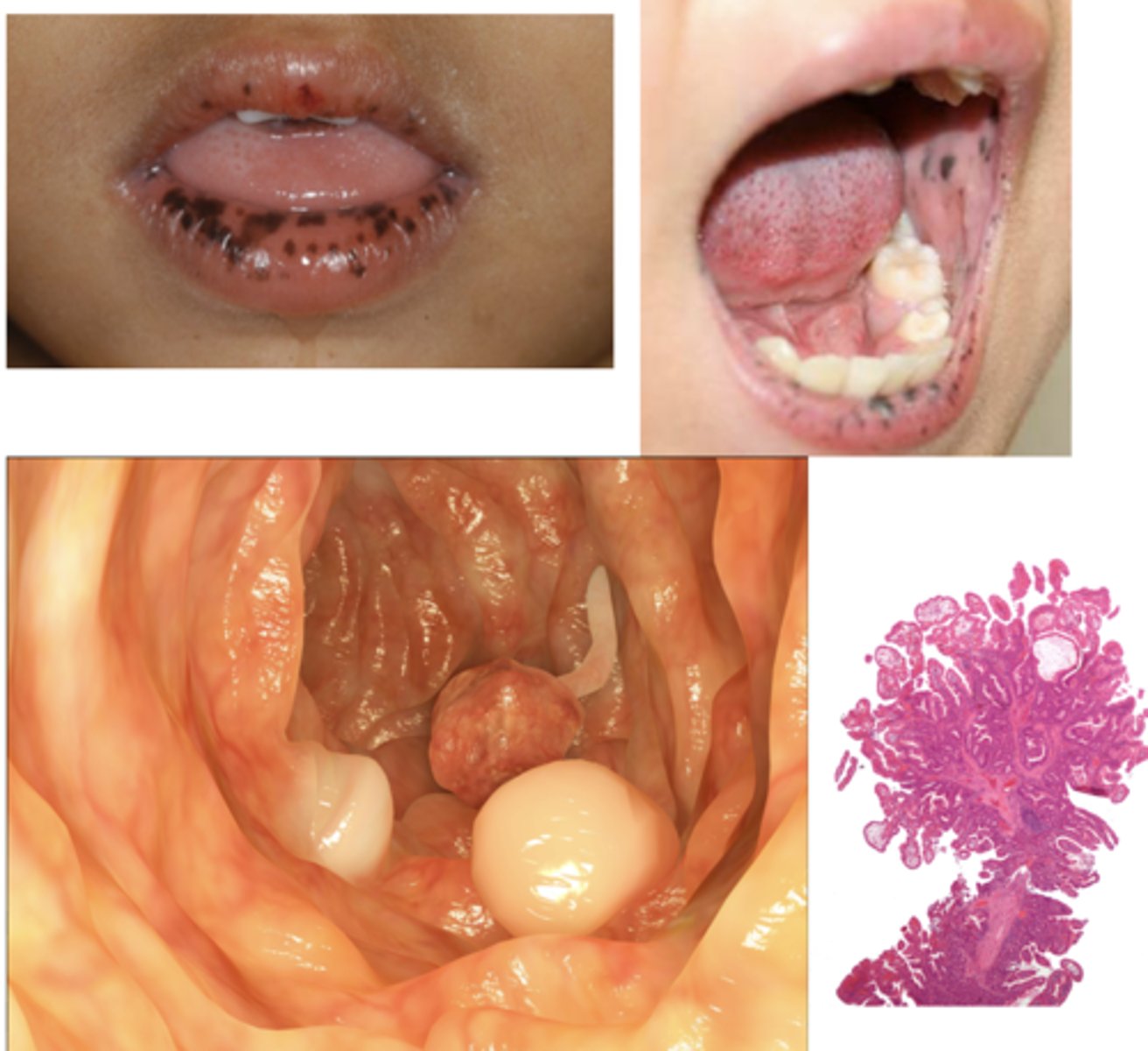 <p>What has the following characteristics?</p><p>- Presentation: Pigmented macules (1-5mm flat dark lesions) on lips and buccal mucosa (83-95%)</p><p>- Can fade after puberty</p><p>- Can also have lesions on fingers, soles and around eyes</p><p>- Autosomal dominant</p><p>- Presents in 1st-3rd decade</p>