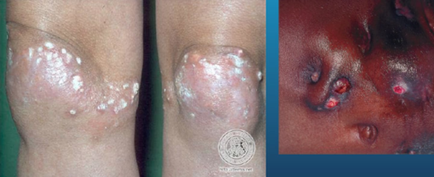 <p>what are the sxs/s of limited systemic sclerosis?</p><p>diffuse?</p>