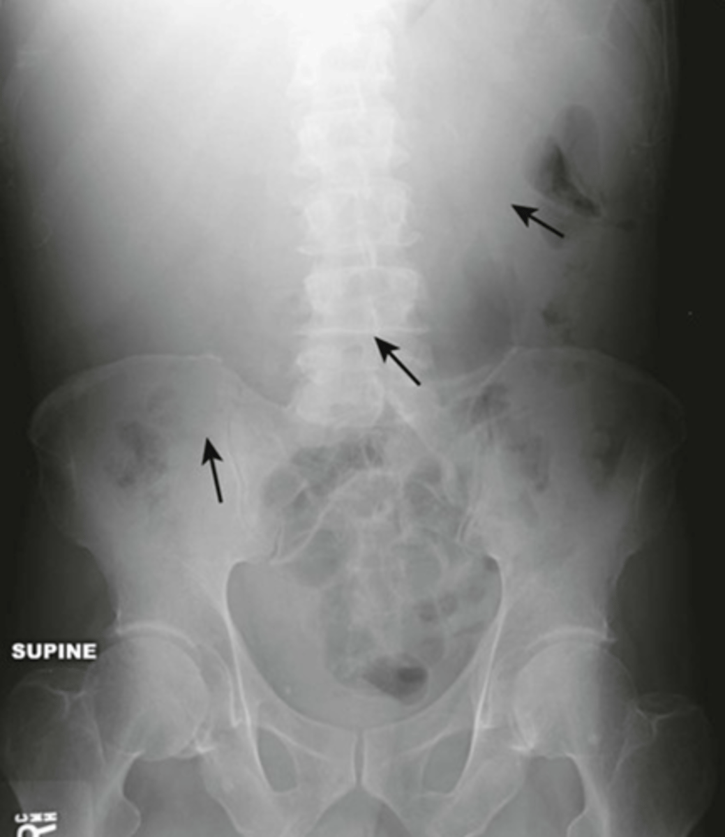 <p>enlarged liver, displacement of all bowel from RUQ down to iliac crest and across midline</p>