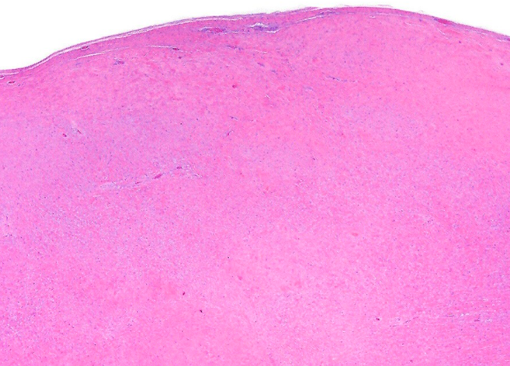 <p>Lésion de la nuque chez homme de 50 ans </p><p>1) diagnostic</p><p>2) clinique (localisation, âge)</p><p>3) histologie et dd </p>