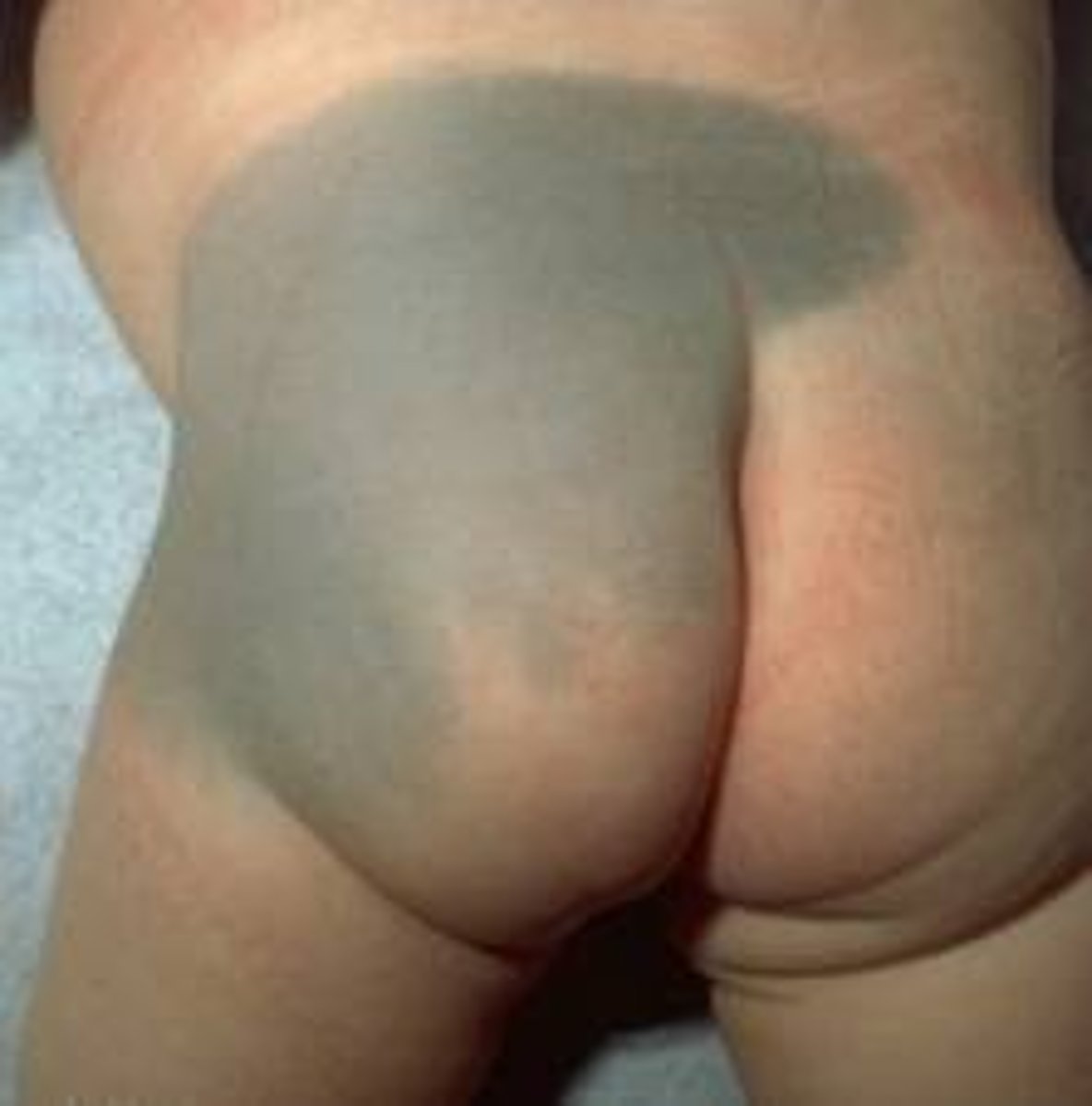 <p>dermal melanocytosis</p><p>Formerly called "Mongolian spots"</p>