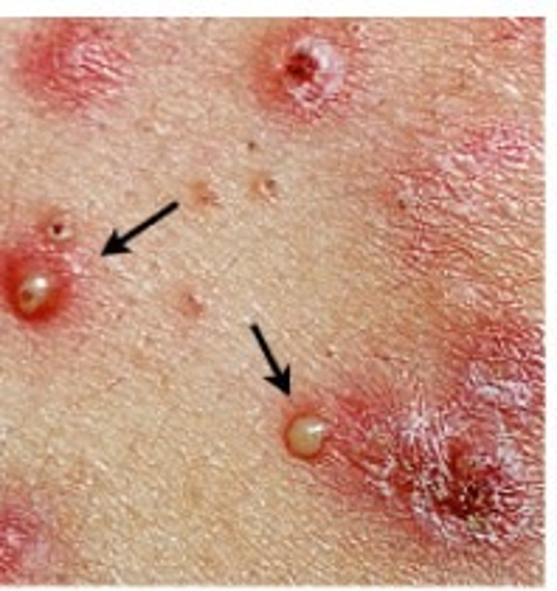 <p>-Circumscribed elevation of the skin</p><p>-Contains purulent exudate (white, yellow, greenish-yellow)</p><p>Examples:</p><p>-Acne</p><p>-Herpes simplex</p>