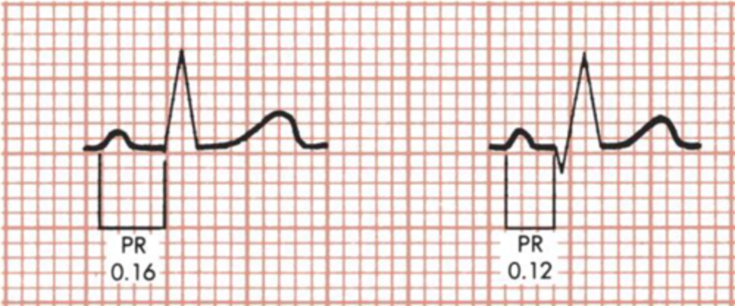 <p>- Is the PR interval measurement within normal</p><p>range? (Normally 0.12 to 0.20 seconds/3 to 5 small squares)</p><p>- Are the PRIs constant?</p><p>- If the PR interval varies, is there a pattern to the</p><p>changing measurements?</p>