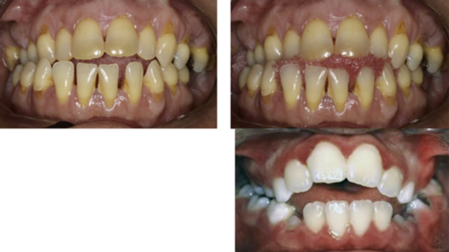 <p>identify the type of bite:</p>