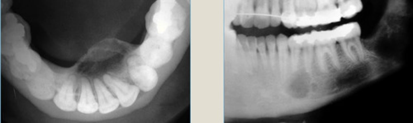 <p>Well-defined capsule w/ radiolucent border.</p><p>Very round + mixed lesion.</p><p>LEFT: cortical expansion in Ant. MN</p><p>RIGHT: Lesion radiolucent at apices of MN PM</p>