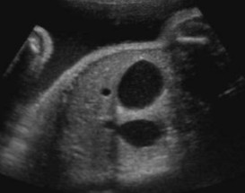 <p>The sonographer found polyhydramnios. This was found.</p><ol><li><p>What US finding is seen here?</p></li><li><p>What pathology is it seen with?</p></li></ol><p></p>