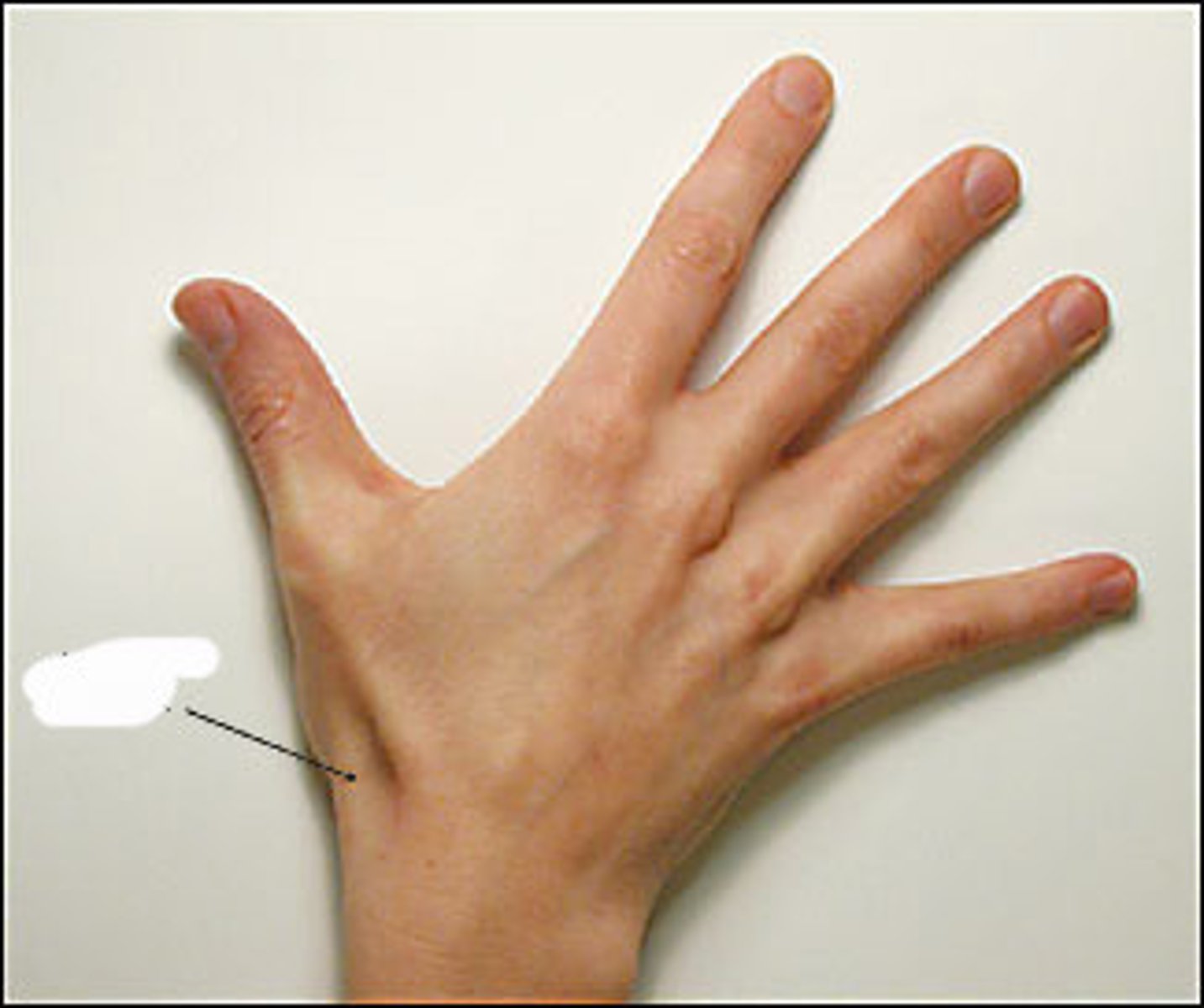 <p>abductor pollicis longus, extensor pollicis brevis, extensor pollicis longus</p>