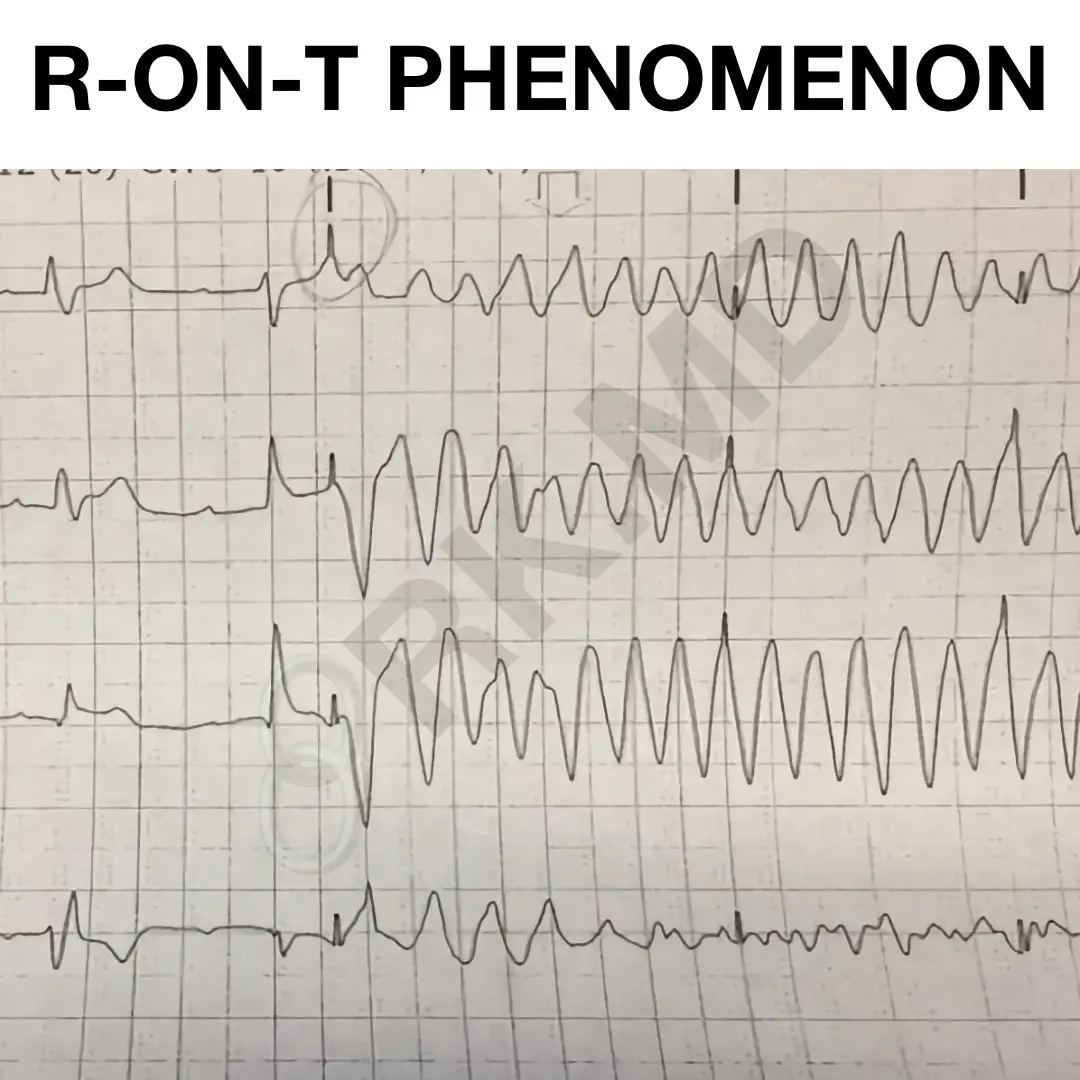 <p>R-on-T phenomenon</p>