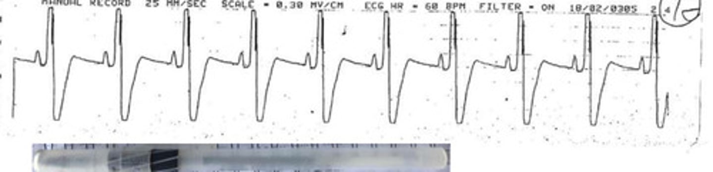 <p>What arrhythmia is this?</p>