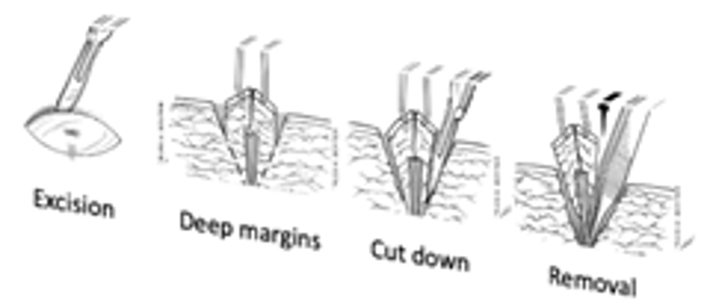 <p>Excision, deep margins, cut down, removal</p>