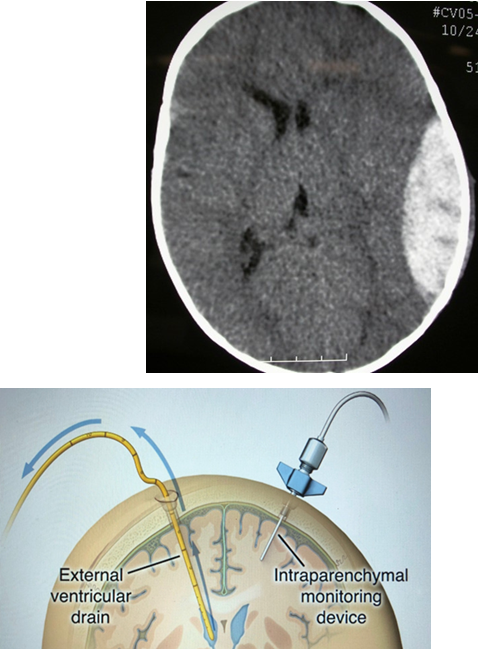 <p>Epidural Hematomas<br><br></p>