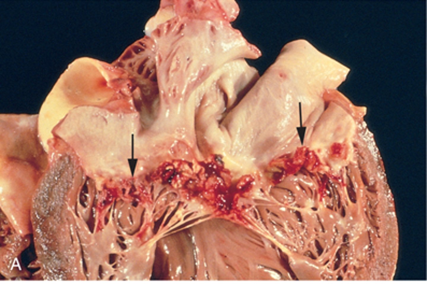 <p>infective endocarditis</p>