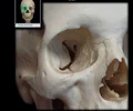 <p>Small foramen in suture between orbital plate of ethmoid bone and orbital surface of frontal bone Connects orbit with ethmoidal sinuses and nasal cavity Transmits anterior ethmoidal nerve, artery, and vein</p>