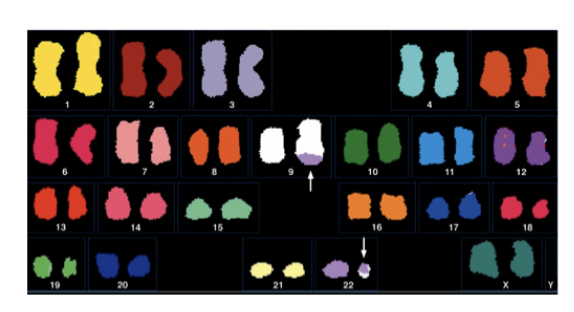 <ul><li><p>product of <strong>reciprocal translocation</strong></p><ul><li><p>between chromosomes 9 and 22</p></li></ul></li></ul><p></p><p><em>Note: translocations can easily be viewed with chromosome paining and spectral kayrotyping</em></p>