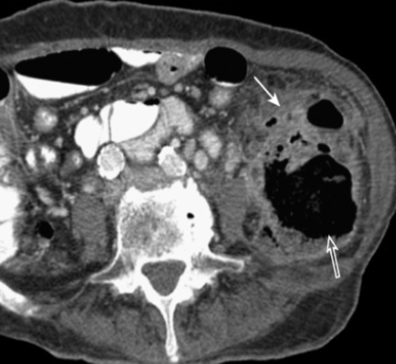 <p>macroscopic inflammation of a diverticulum, may lead to microperforation, abscess, or peritonitis</p><p>S/Sx: aching LLQ pain, N/V, constipation or loose stools</p><p>Abdominal CT + f/u Colonoscopy or CT colonography</p>