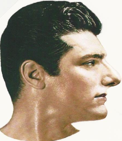 <p><span>Receding forehead; Straight Chin</span></p>