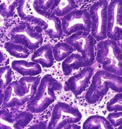 ### Hyperplasia - *Endometrial*