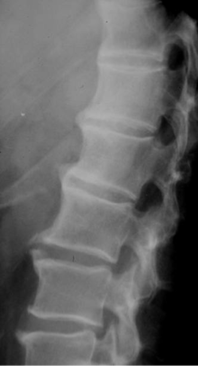 <p>State the criteria for diffuse idiopathic skeletal hyperostosis (DISH)</p>