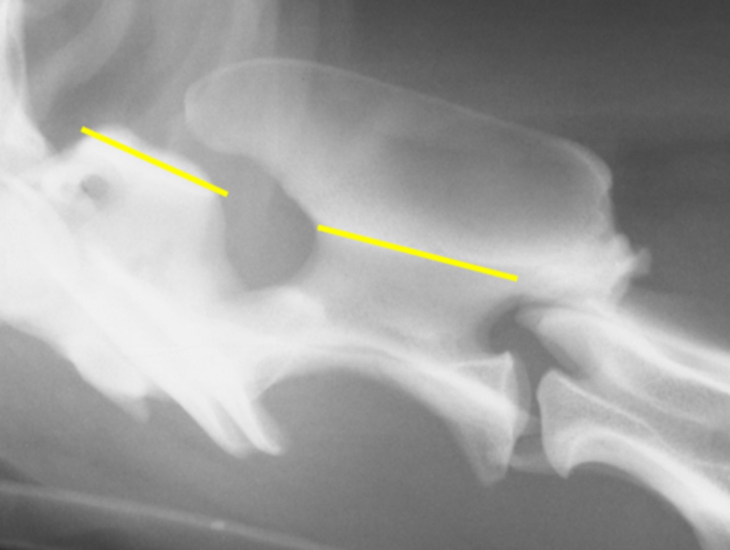 <p>Dorsal arch of C2 should overlap C1, and</p><p>Linear alignment of dorsal lamina</p>