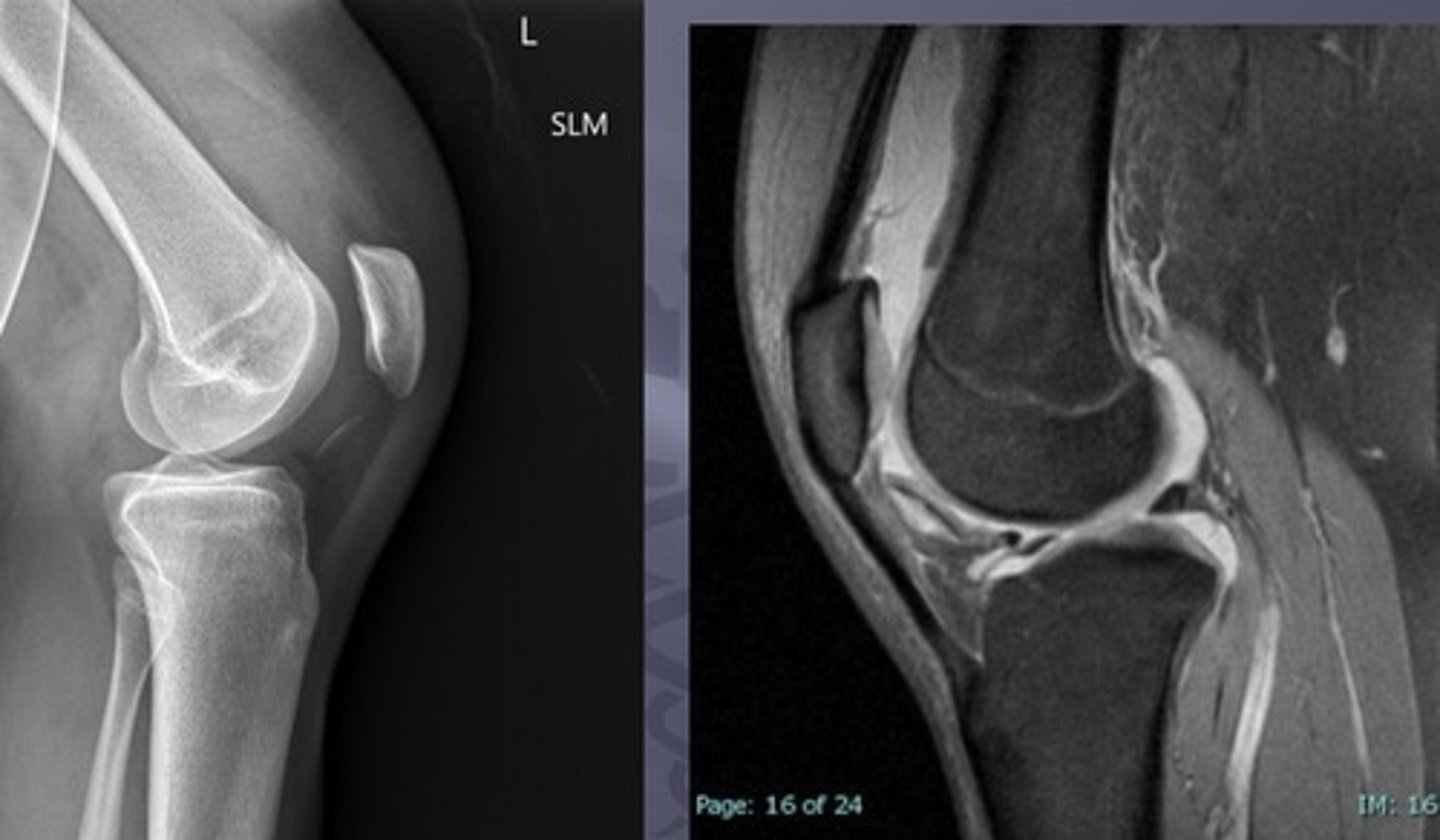 <p>probably due to a loose body (e.g. a bone or cartilage fragment)</p>