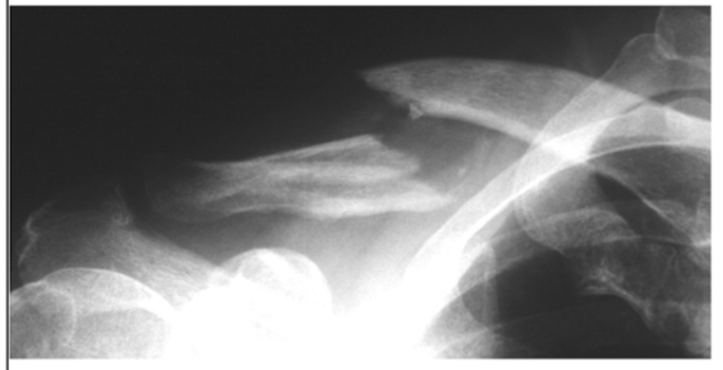 <p>AP view</p><p>10 degrees cephalic tilt</p>