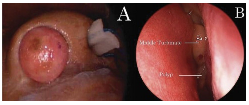 <p>A 6-year-old boy seen in a physician's office has had chronic nasal congestion and noisy breathing for several months. His parent reports mucoid rhinorrhea that is present every day and worsens intermittently. The boy often has difficulty breathing through his nose, especially when sleeping. Past trials of antihistamines or antibiotics have only provided temporary improvement in symptoms. He has no history of serious bacterial infections, pneumonia, or asthma. His growth and development have been appropriate for his age. He eats a regular diet and has normal stool and urine output. On examination of the nasal passages, the attending physican notes glistening, bluish-gray, grape-like masses bilaterally. The remainder of the physical examination findings are unremarkable. The most common cause of this condition in children is best evaluated by performing:</p>