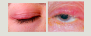 <p>blepharitis</p>