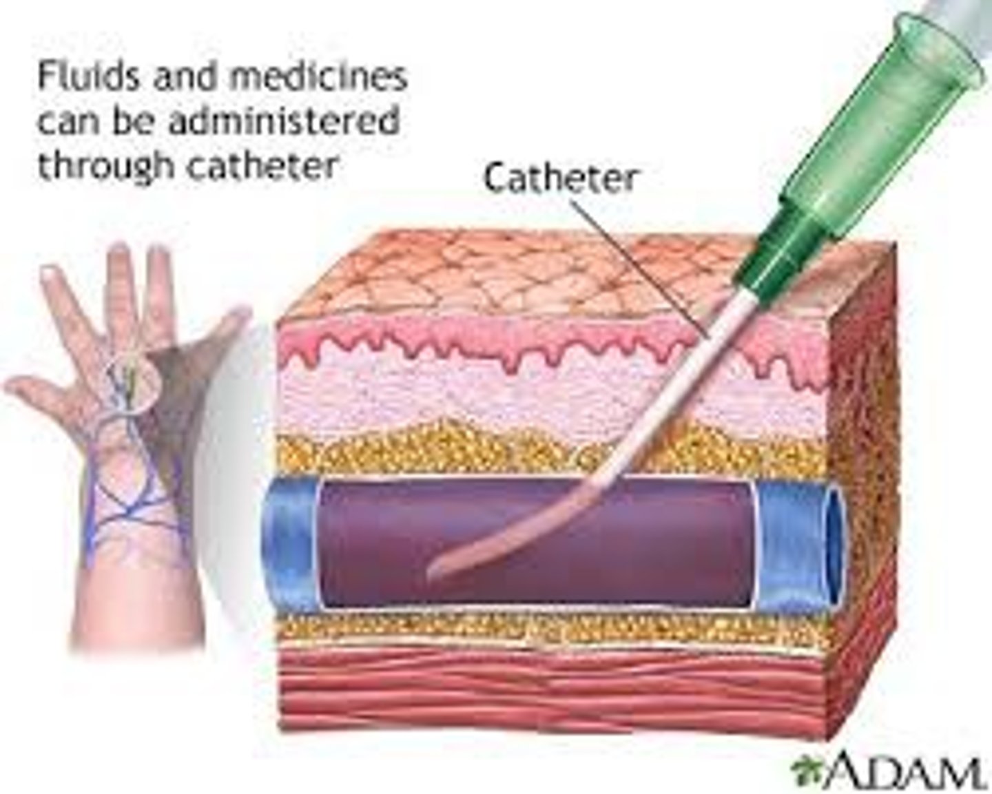 <p>1/11 Route of Administration</p><p>- needle-catheter into a VEIN</p><p>- IMMEDIATE absorption= fast onset of action</p><p>- amount of dose given = amount of dose circulating to receptors</p><p>- SYSTEMIC effect</p><p>- common in hospital settings</p><p>- 'expensive': bs u need professional to inject IV's</p><p>- INFECTION risk (esp immunocompromised ppl)</p>