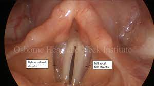 <ul><li><p>organic, structural</p></li><li><p>thinning and bowing of the vocal folds</p></li><li><p>often age-related</p></li><li><p>posterior gap causes a spindle vibrating pattern</p></li></ul>