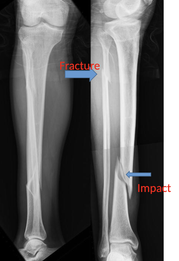 <p>Name this fracture</p>