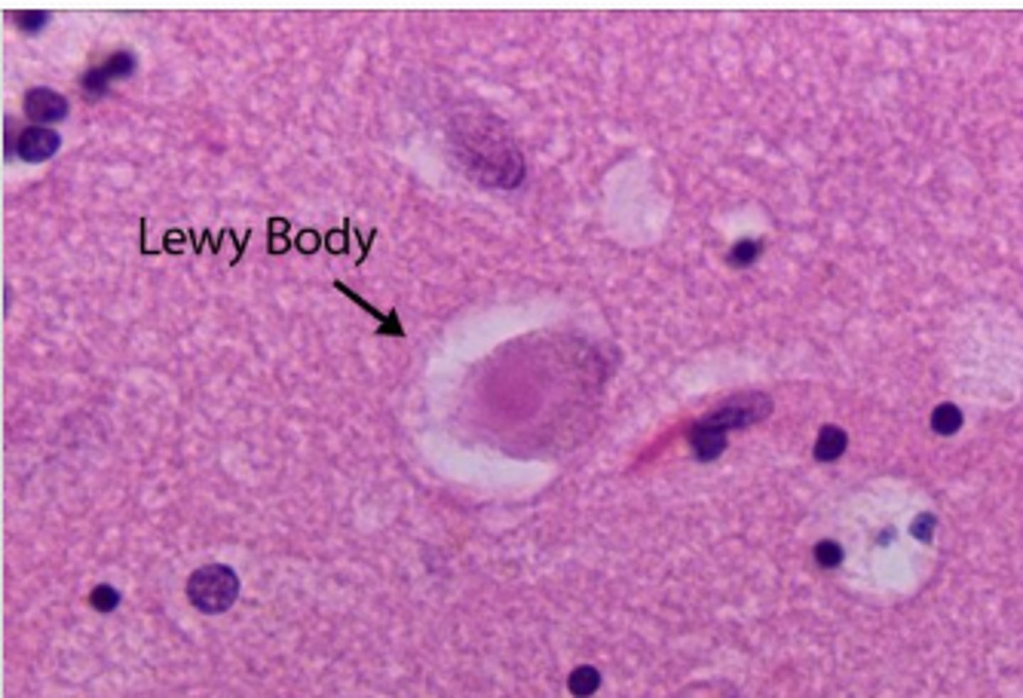 <p>- rapidly progressive form of dementia</p><p>- Parkinsonism → Dementia</p>