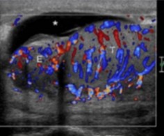 <p>This scan was done on a patient whose had symptoms of urethral discharge. What can be assumed here?</p>