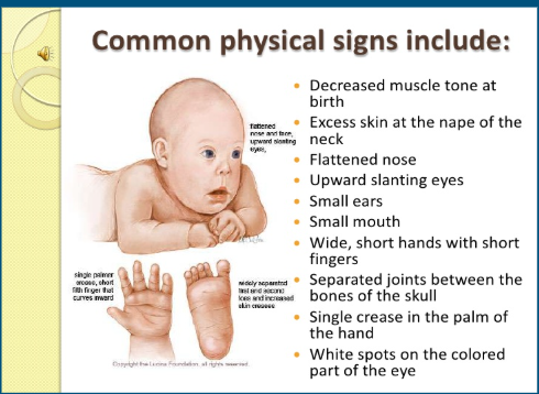 <p><span style="background-color: transparent;">-3 copies of chromosome 21</span></p><p><span style="background-color: transparent;">-1/600-800 live births</span></p><p><span style="background-color: transparent;">-mild to severe</span></p>