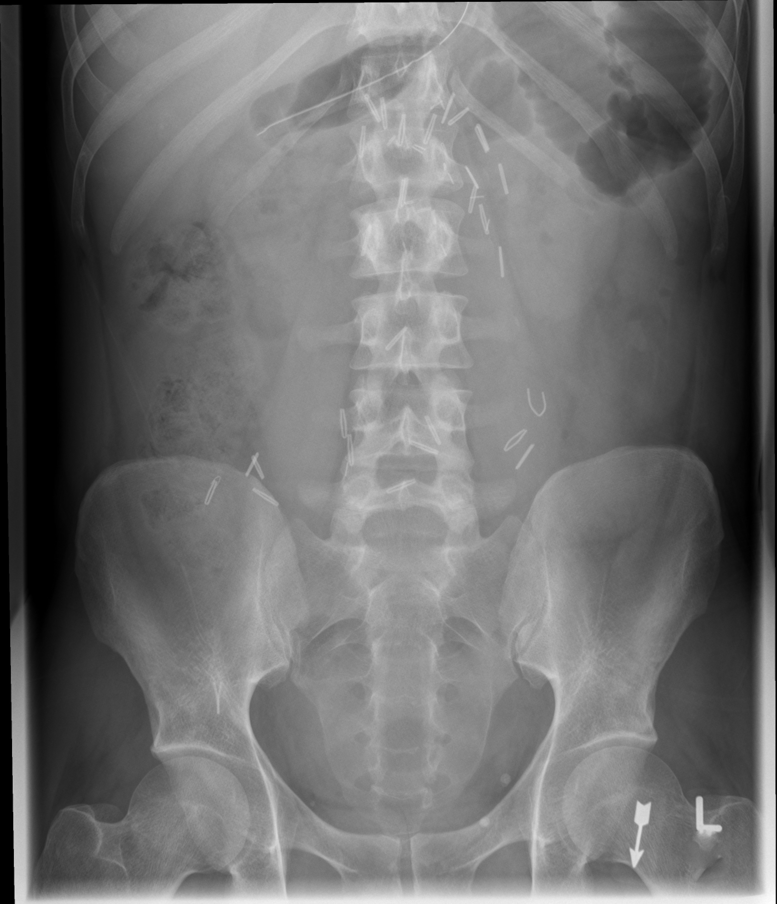 <p>From T11/T12 to the pubic symphysis, including bilateral flank stripes.</p>