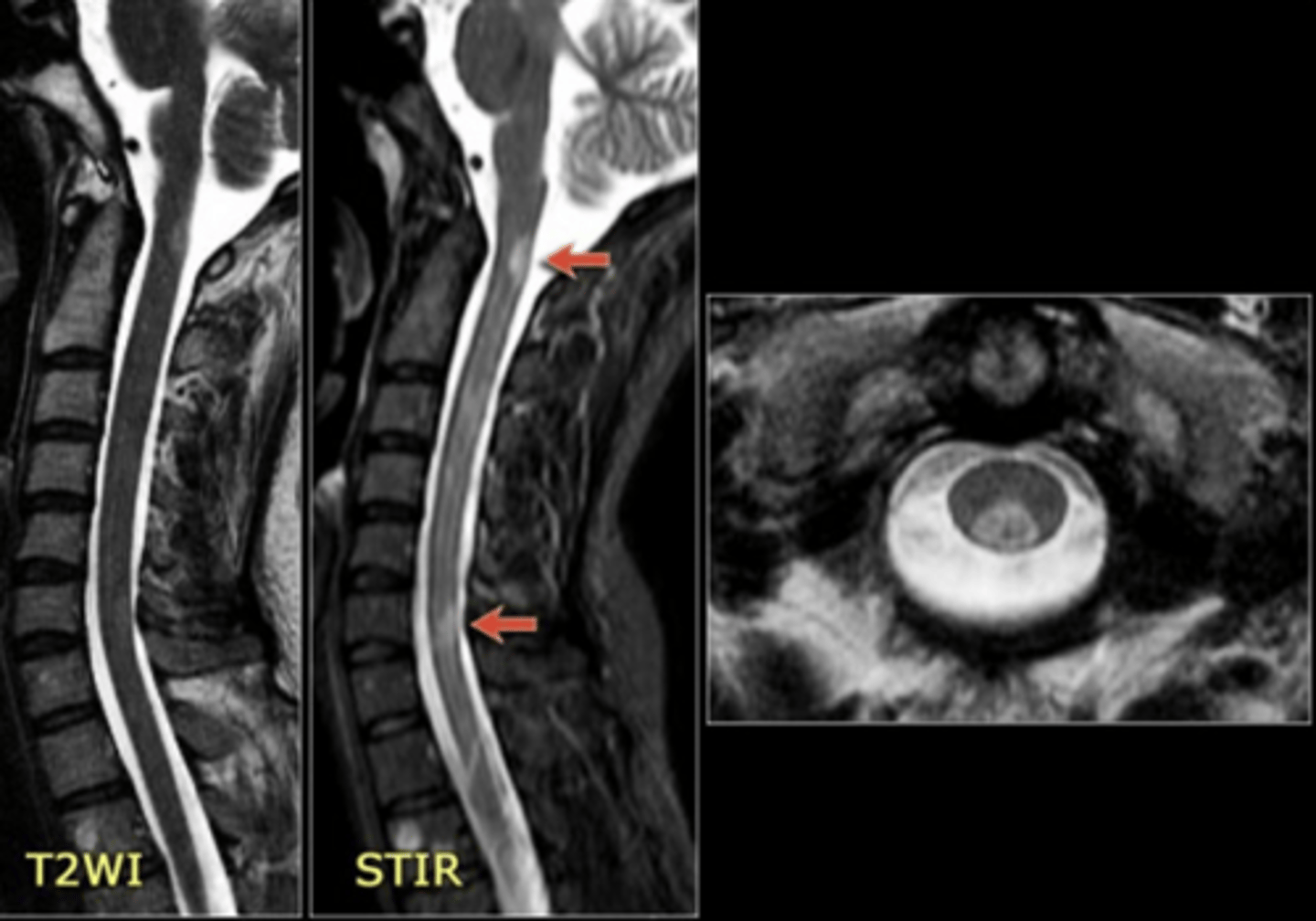 <p>weakness, numbness, bowel.bladder dysfunction, band-like sensation (MS hug), hemibody sensory changes</p>