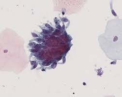 <p>Hyperchromatic crowded groups avec différenciation glandulaire (rosettes, feathering).</p><p>1) diagnostic principal</p><p>2) dd pertinents</p><p>3) clés d’exclusion</p><p>4) conduite</p><p></p>