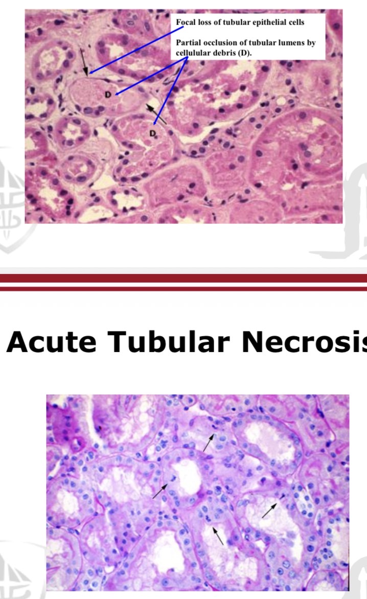 <p>• Medullary Ischaemia</p><p>• Tubular damage</p><p>• Tubular Obstruction secondary to</p><p>sloughing of tubular cells and debris</p>