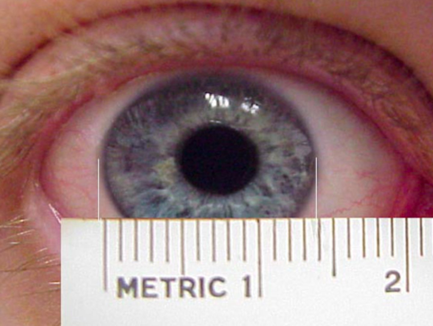 <p>enlarged cornea</p>