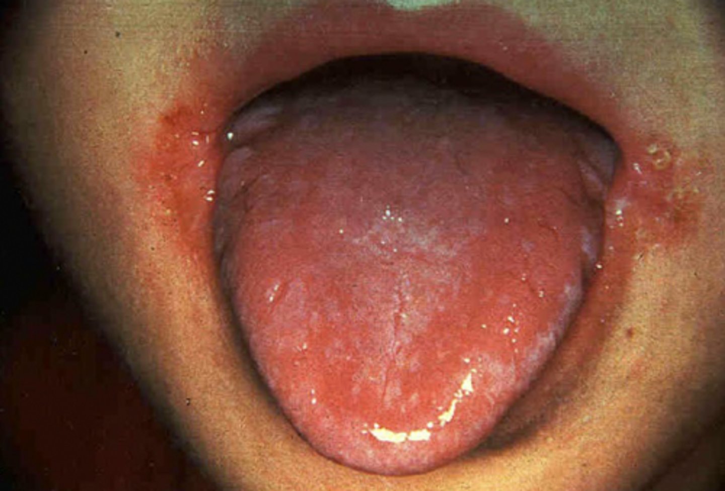 <p>-glossitis</p><p>-angular cheilitis</p><p>-sore throat</p><p>-swelling and erythema of oral mucosa</p><p>-seborrheic dermatitis - skin</p><p>-+/- anemia</p>