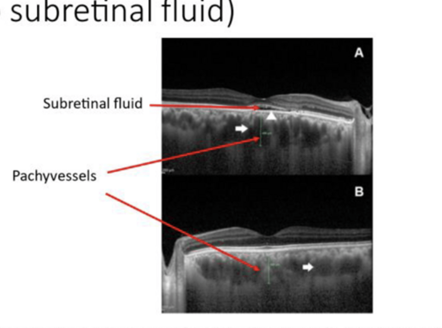 <p>Pachyvessels will be (small/large) in Central Serous Chorioretinopathy?</p>
