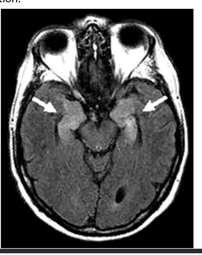 <p>patient presents with apathy, confusion, memory difficulty, disorientation, sexual disinhibition, MRI shows white fattening in limbic system (amygala and hippocampus) , patient has _____ ______ where antibodies (gaba-b) target the limbic system, chest x ray showed lung masses which were cancerous </p>