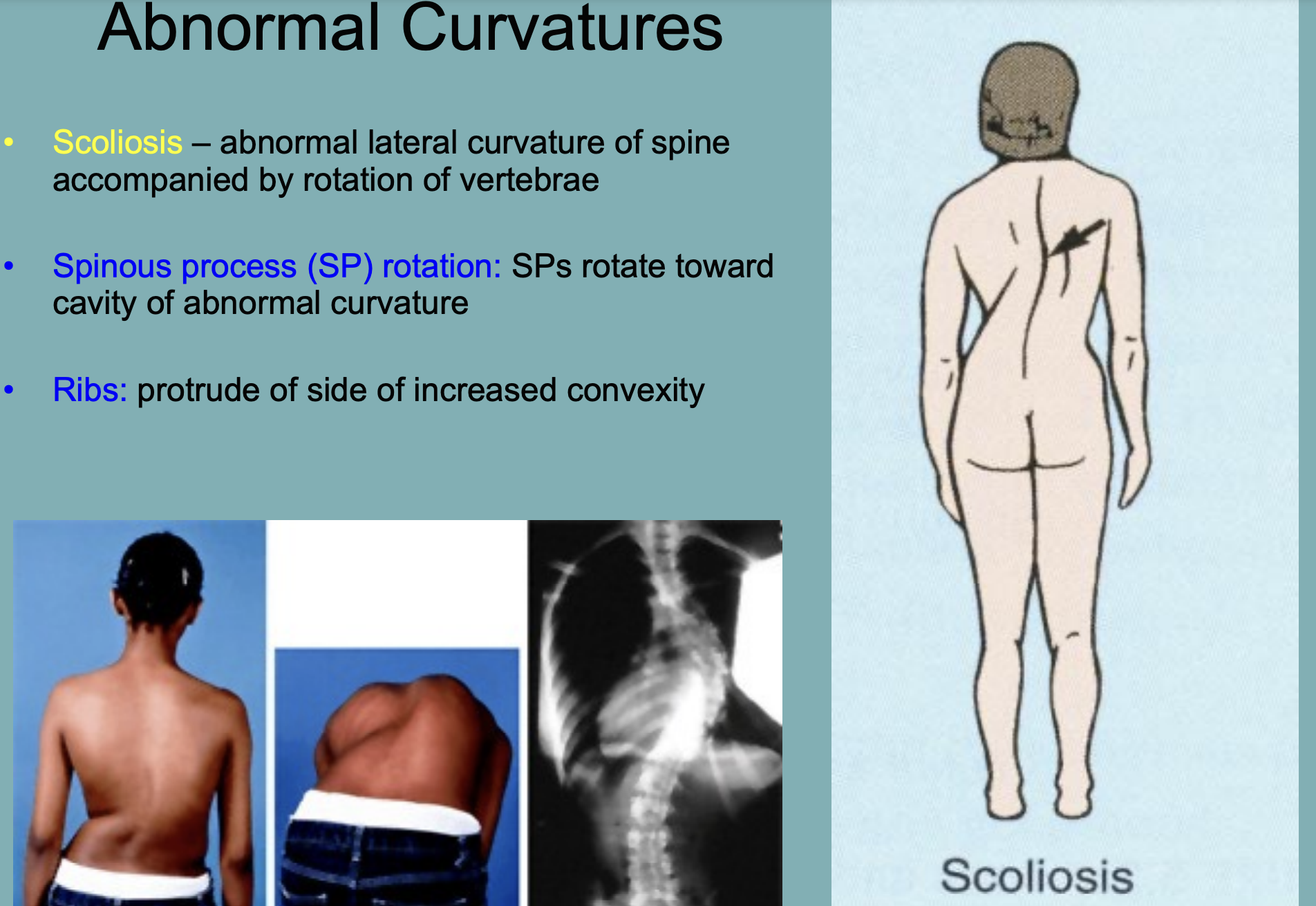 SPs rotate toward the cavity of abnormal curvature 