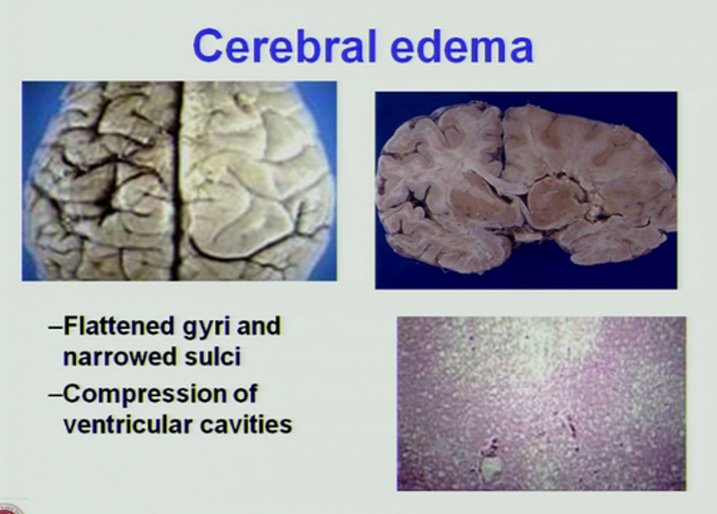 <p>Swelling on the brain</p>