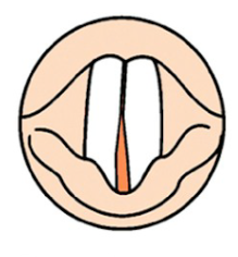 What type of VF closure is this?