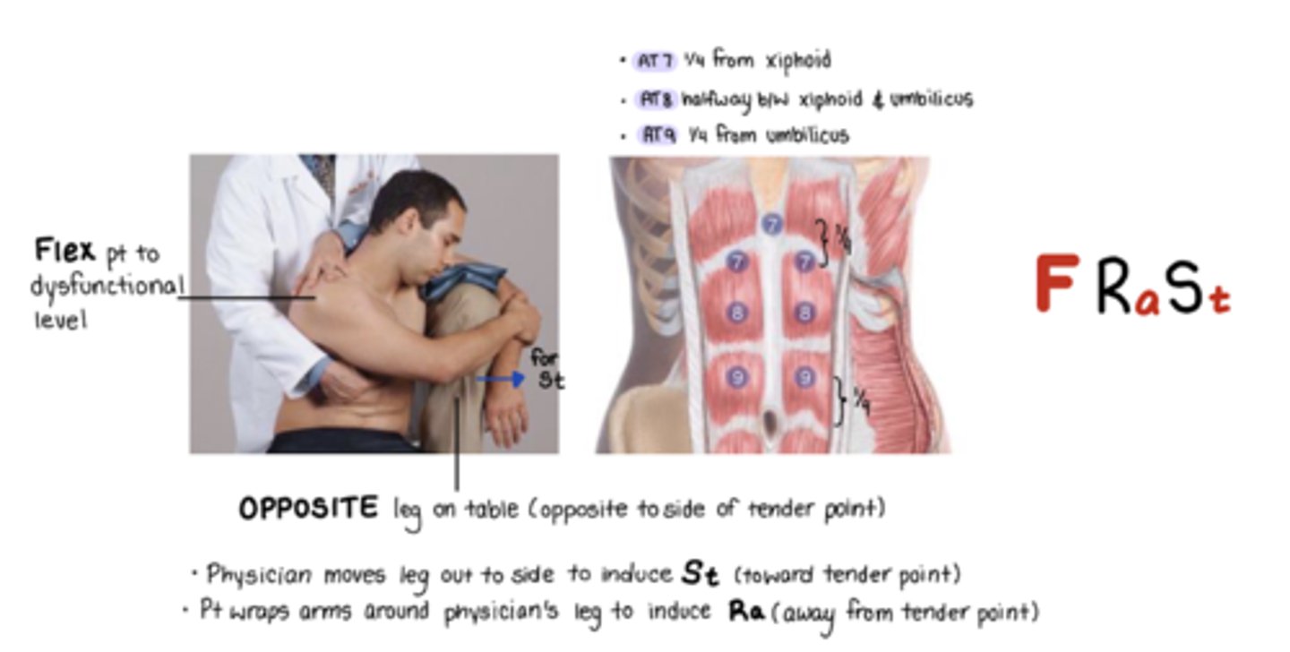 <p>F Ra St</p><p>halfway xiphoid and umbilicus</p><p>St = move leg out to induce pt side bending toward TP</p><p>Ra = pt wraps arm around physicians leg to induce Ra from TP</p>