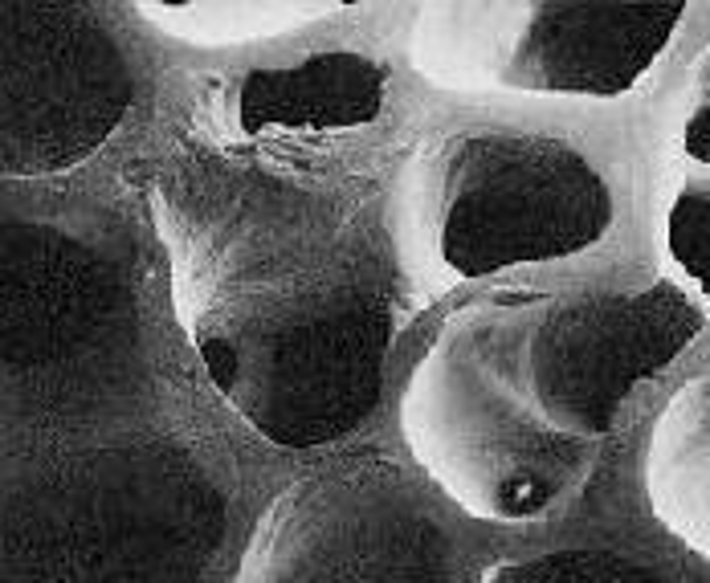 <p>Increased risk of osteoporosis and bone fractures, and HIP fractures</p>