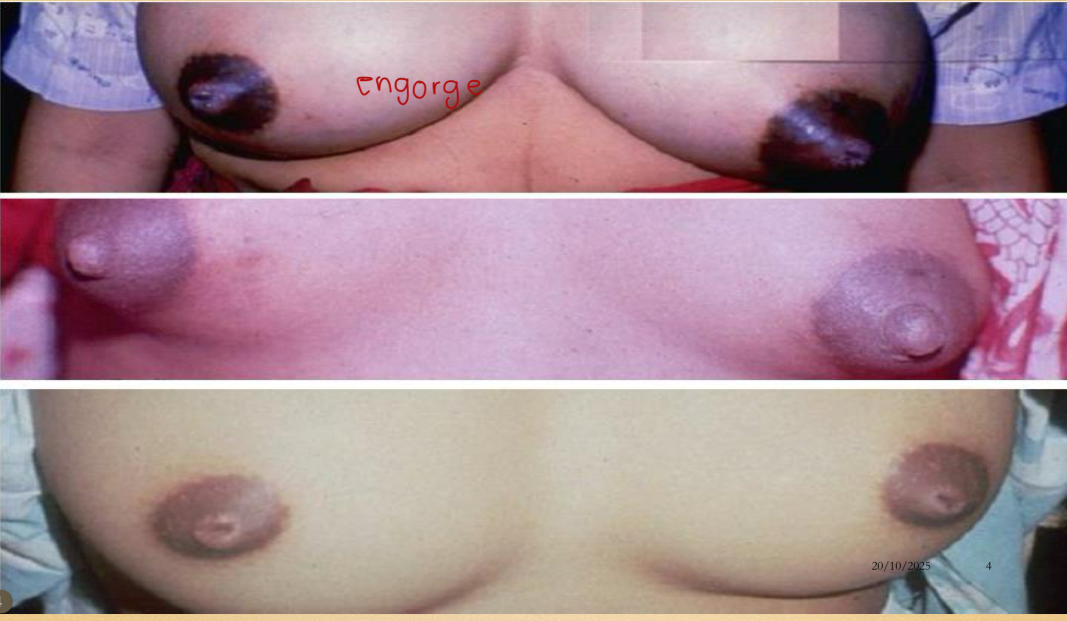 <p>Briefly explain breast engorgement in terms of</p><ul><li><p>when does it usually happen</p></li><li><p>clinical presentation</p></li><li><p>treatment </p></li></ul><p></p>