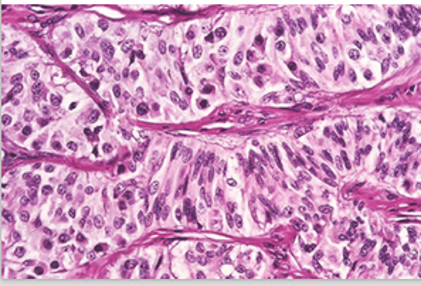 <p>Sertoli cells multi-layered in tubules or invading interstitial tissue</p><p>Abundant fibrous tissue</p>